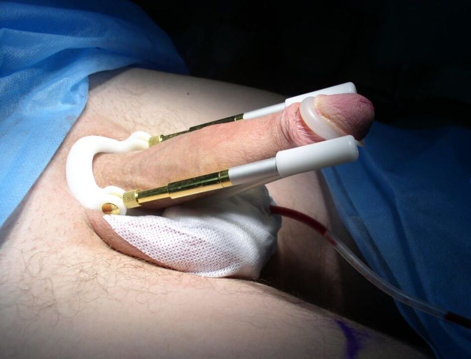 extensor after penis enlargement surgery