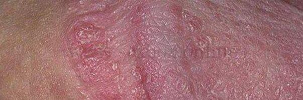 Dry skin and ulcers on the head of the penis after using sodium bicarbonate