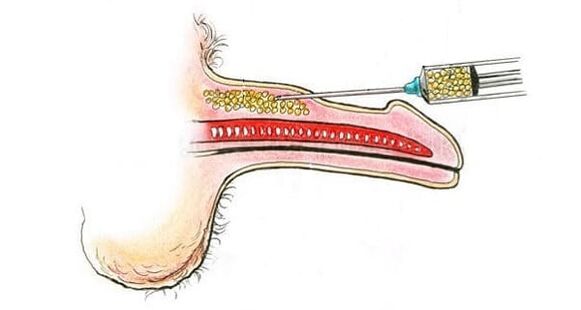 Muscle tissue transplant for penis enlargement