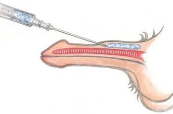 A dangerous method of penis enlargement by Vaseline injections